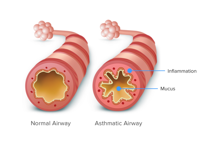 Graphic of normal airway compared to asthma airway